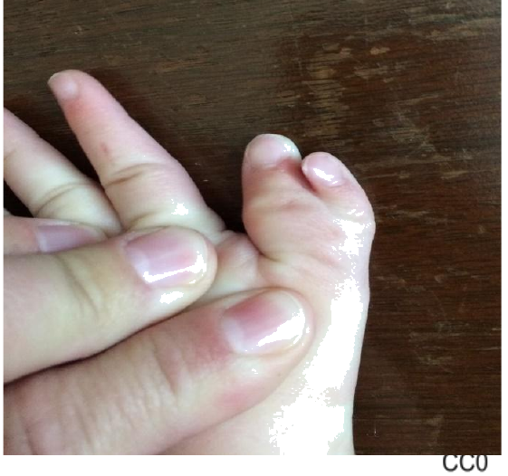 A foot with an extra toe, illustrating a mutation that causes changes in traits.